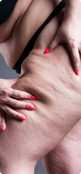 Imagem das coxas de uma mulher após a cirurgia de Lipedema